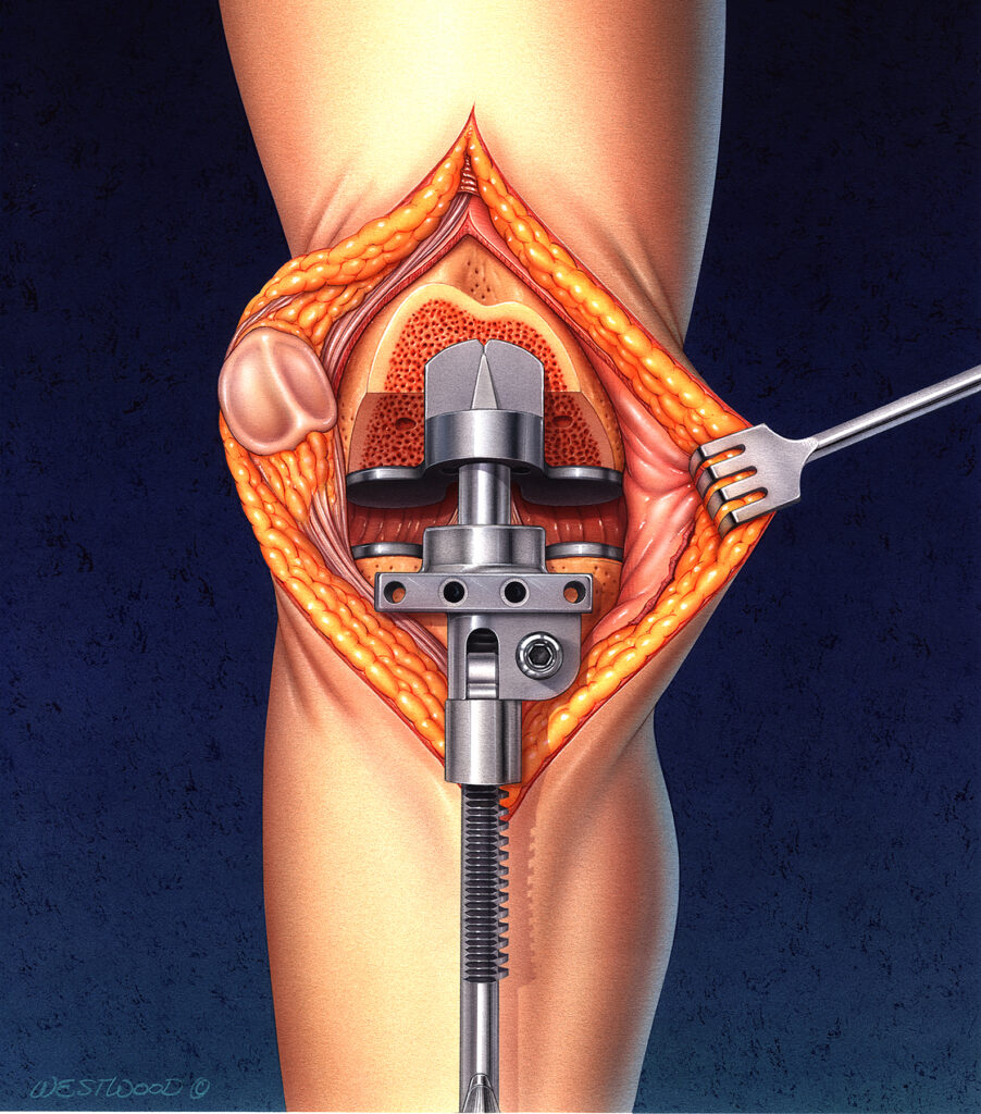 Illustration of a knee surgery showing an open incision with surgical tools and an implant in the joint.