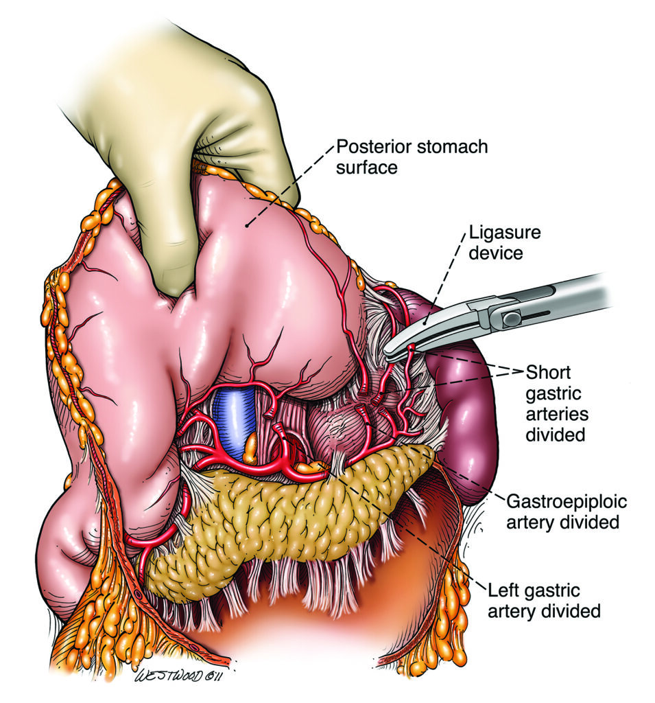 Illustration showing stomach arteries being divided with a ligasure device during a surgical procedure.